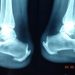 X-Ray taken by a heel pain podiatrist in Essendon